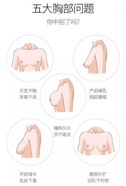 乳房下垂缓解怎么样好不好? 乳房下垂缓解怎么样好不好?