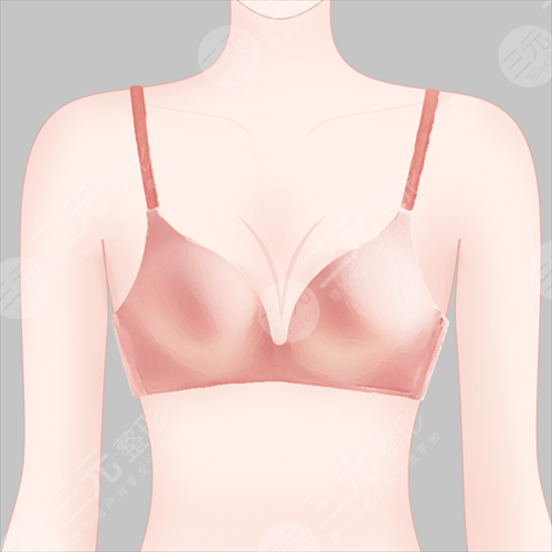 乳房下垂矫正手术适应症有哪些 乳房下垂矫正手术适应症有哪些