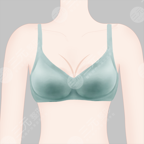 乳房下垂怎么办 乳房下垂整形术前注意事项