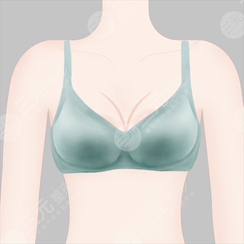 乳房下垂怎么办 乳房下垂整形术前注意事项 乳房下垂怎么办 乳房下垂整形术前注意事项