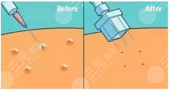 水光补水多久做一次喜欢 它的维持时间是多久? 水光补水多久做一次喜欢 它的维持时间是多久?