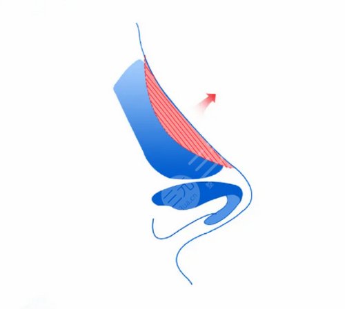 丰胸手术