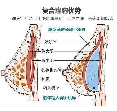 隆胸究竟好不好?有什么并发症和风险我们要知道?