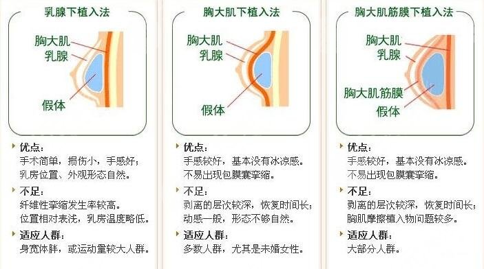 乳房整形前后对比