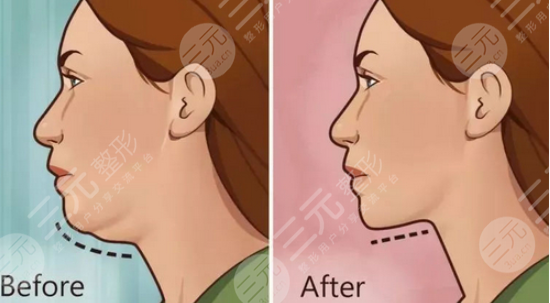 光纤溶脂和吸脂的区别