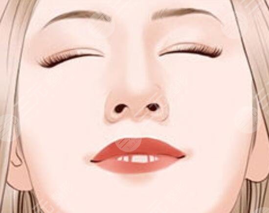 玻尿酸去除法令纹好吗