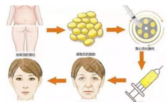 填充眼窝的脂肪很硬