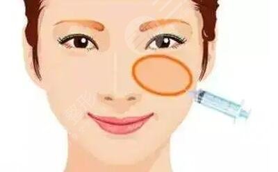 眼部注射玻尿酸好不好