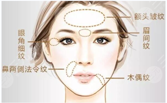 ****注射除皱成好吗