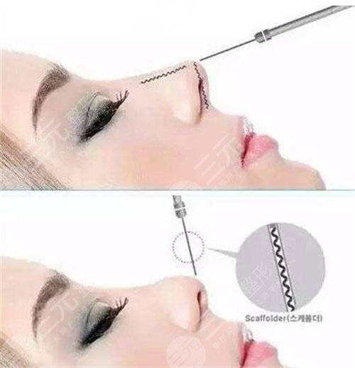 鼻翼鼻尖整形手术的果好不好