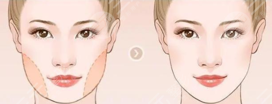 ****注射除皱成好吗