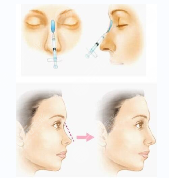 玻尿酸填充鼻唇沟成好吗