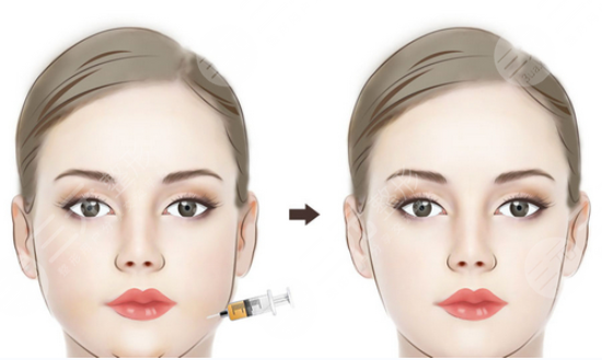 ****注射除皱成好吗