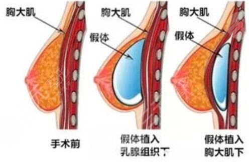 隆胸手术案例参考