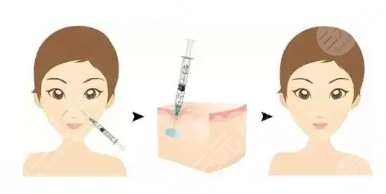 ****注射除皱术降低风险吗