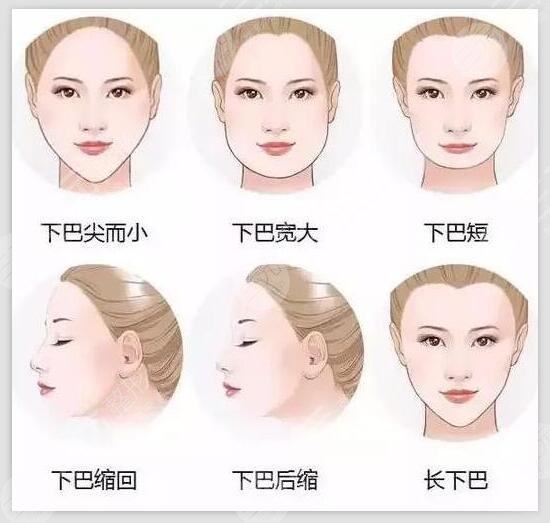 玻尿酸丰下巴价格多少