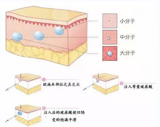 玻尿酸填泪沟经验