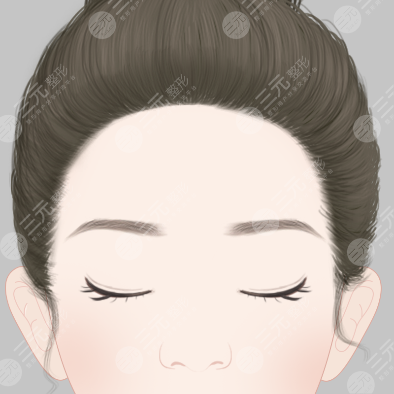 面部填充手术方法
