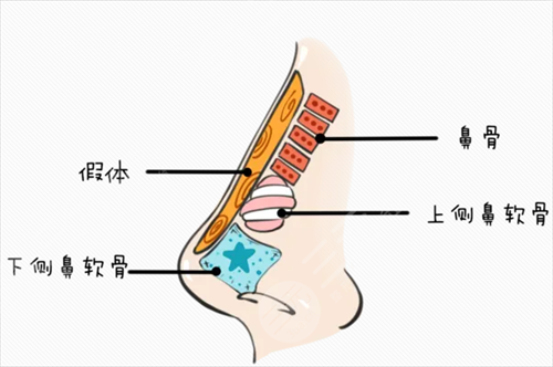 骨膜下隆鼻术整形前