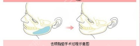 去颊脂垫有副作用吗 去颊脂垫有后遗症吗