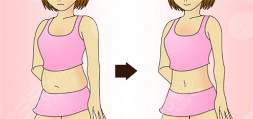 腹部吸脂减肥成好吗 腹部吸脂减肥会反弹吗