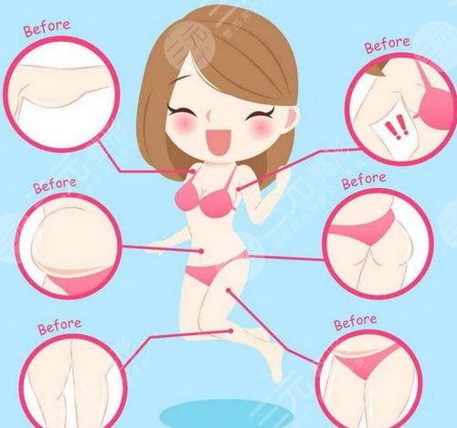 腹部吸脂减肥成好吗 腹部吸脂减肥会反弹吗