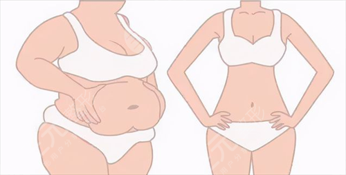 腰腹部吸脂减肥会影响怀孕吗 未婚女子可以做腰腹部吸脂减肥吗