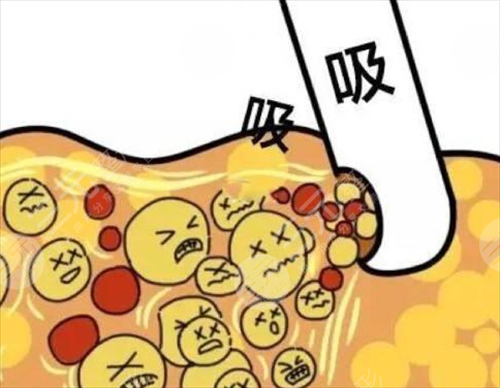 什么是腰腹部吸脂 腰腹部吸脂有后遗症吗