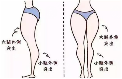 大腿吸脂手术有什么优点 大腿吸脂手术后会留疤吗