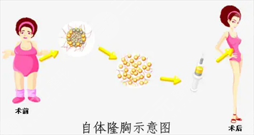 自体脂肪丰胸怎么样 自体脂肪丰胸的成好吗