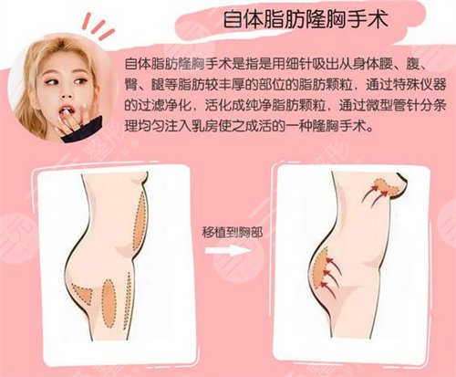 自体脂肪丰胸怎么样 自体脂肪丰胸的成好吗