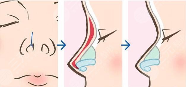 做隆鼻手术是否