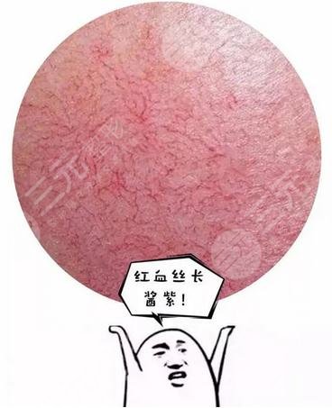 脸上红血丝是身体出了问题吗