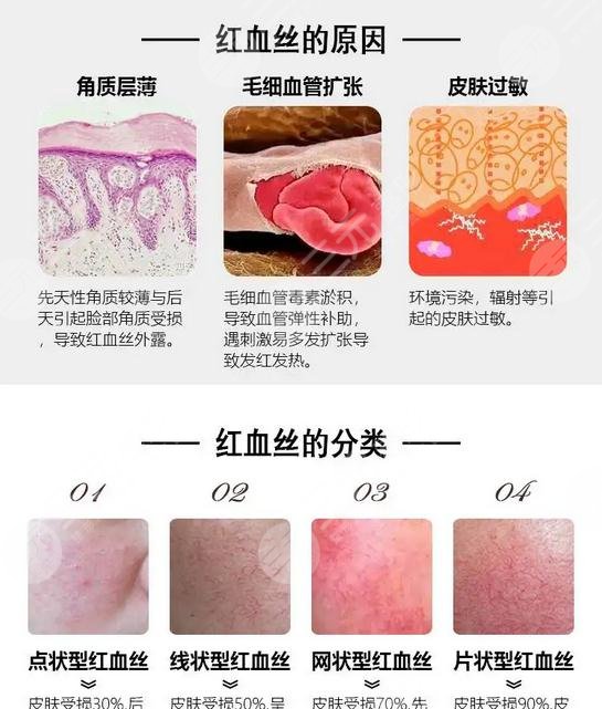 红血丝应该怎样预防