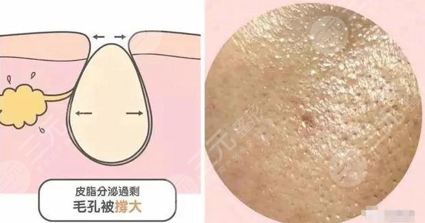 什么办法可以让毛孔缩小