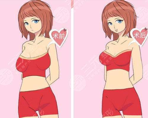 矫正乳房下垂的方法