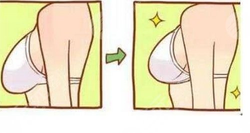 乳房下垂上提矫正手术的并发症