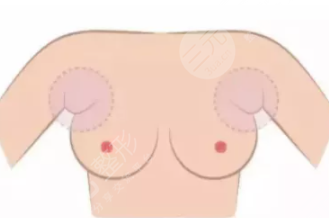 附乳祛除手术多久能恢复？会留疤吗？多少钱？