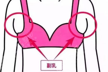 副乳怎么消除？有什么Z快的有缓解方法？