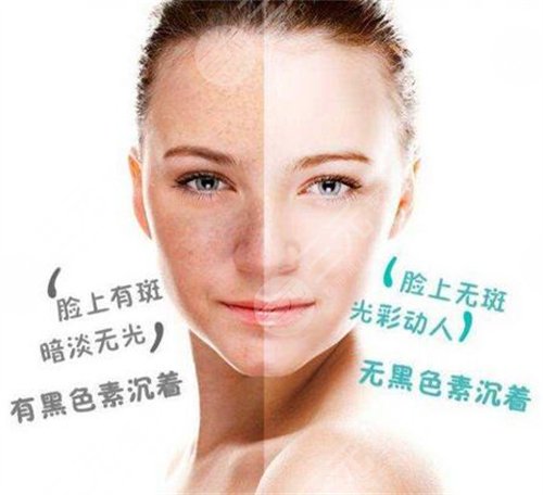 光子嫩肤适合人群有哪些?