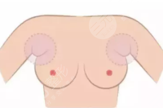 胸部整形副乳切除术的注意事项有哪些呢?