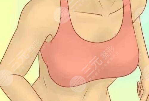 胸部副乳整形有哪些切除手术方式和术后注意事项