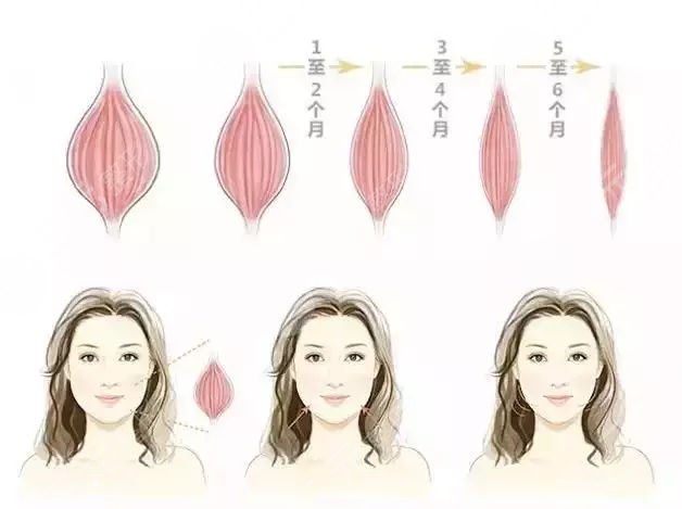 面部吸脂要多久才能看到果