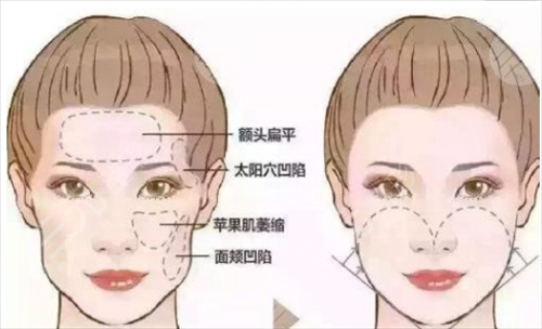 面部脂肪填充果怎么样 术后需要休息吗