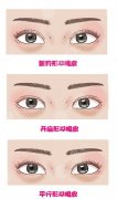 微切内外眦术　外眦赘皮矫正