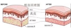 <b>HRF瘦身紧致</b>