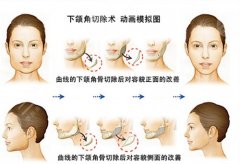 <b>颌角整形口内术后10点</b>