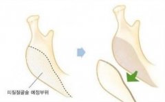 <b>隆下巴修复六方法</b>