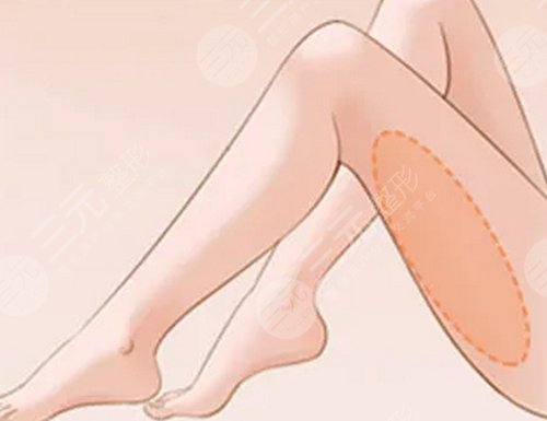 ****注射瘦腿降低风险吗