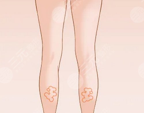 大腿肉注射瘦腿能打吗